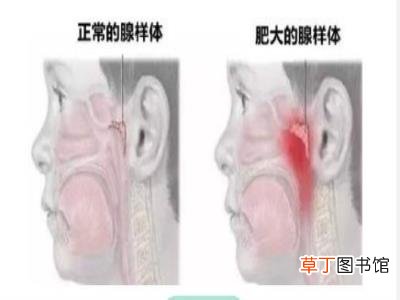 长期张嘴呼吸易致面容变丑张嘴呼吸有哪些危害