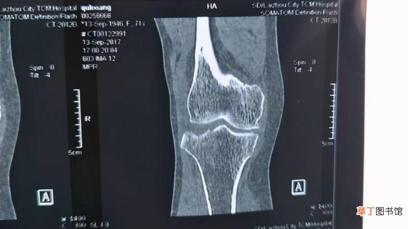 桡骨小头骨折大概多久能恢复 桡骨小头骨折多久能好