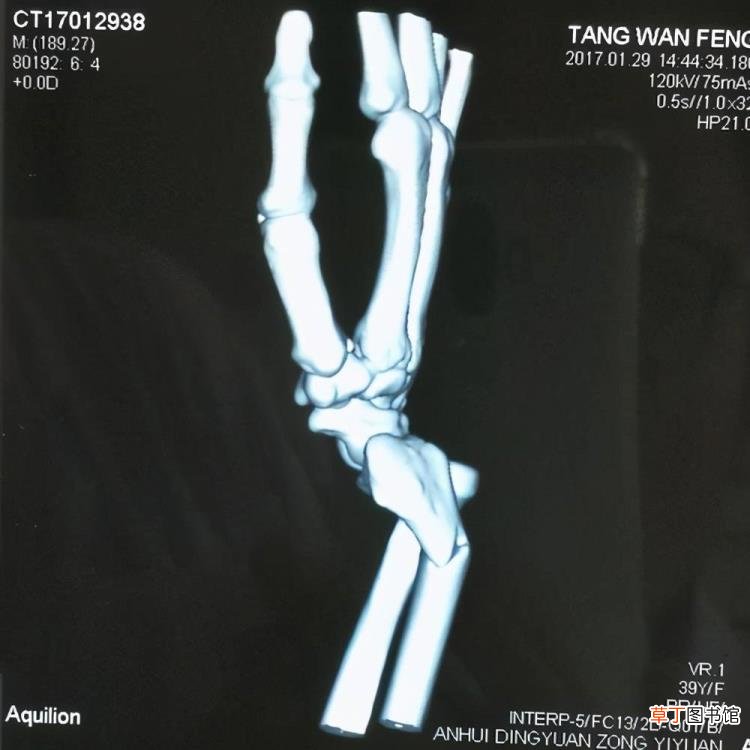 桡骨小头骨折大概多久能恢复 桡骨小头骨折多久能好