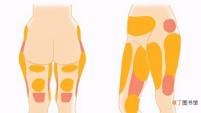 大小腿吸脂多久可以正常走路 腿部吸脂恢复多久