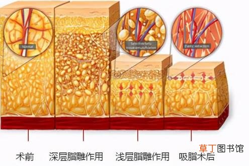 大小腿吸脂多久可以正常走路 腿部吸脂恢复多久
