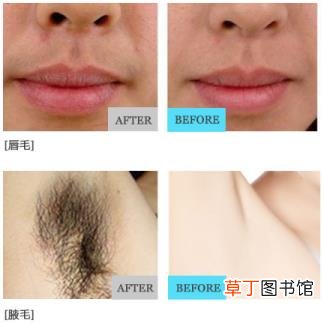 冰点脱毛后多久能碰水 脱毛维持多久