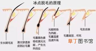 冰点脱毛后多久能碰水 脱毛维持多久