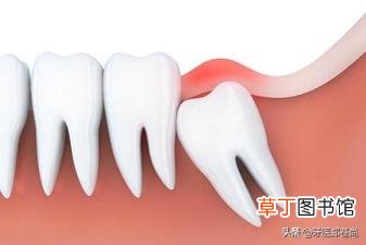 拔四颗牙矫正多久填满 拔颗牙要多久