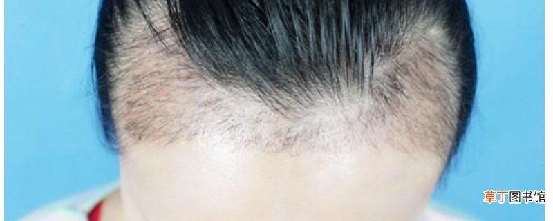 发际线高适合寸头吗