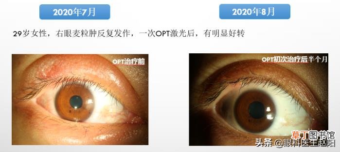 做完opt嫩肤后的注意事项 opt多久做一次
