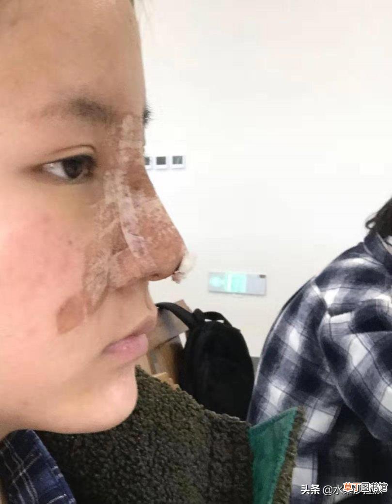 隆鼻后拆线疼吗 隆鼻后疼多久