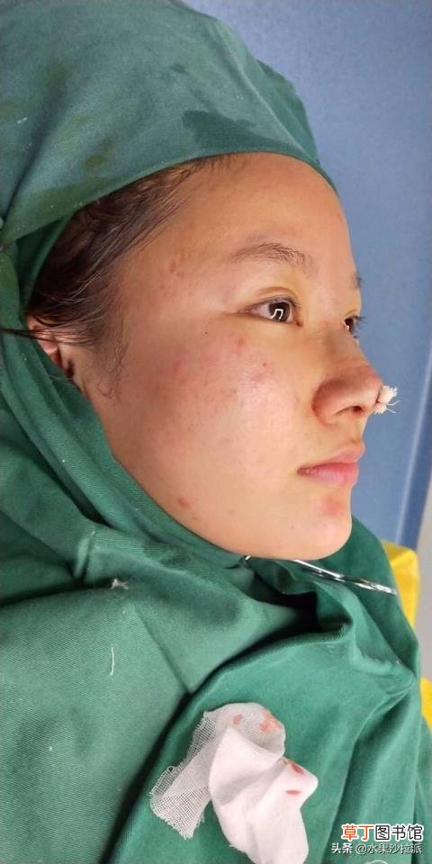 隆鼻后拆线疼吗 隆鼻后疼多久