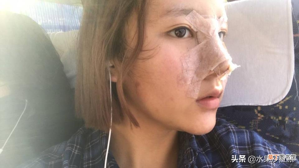 隆鼻后拆线疼吗 隆鼻后疼多久