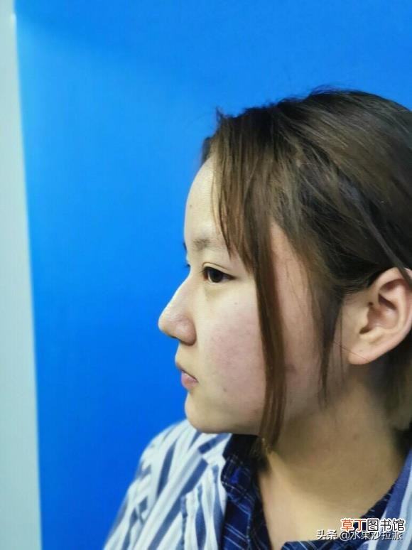 隆鼻后拆线疼吗 隆鼻后疼多久