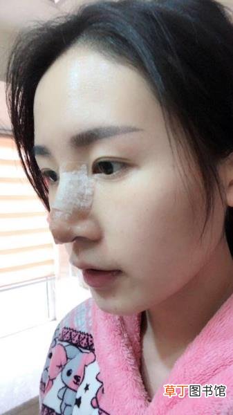 隆鼻消肿后鼻子会矮多少 鼻头多久消肿