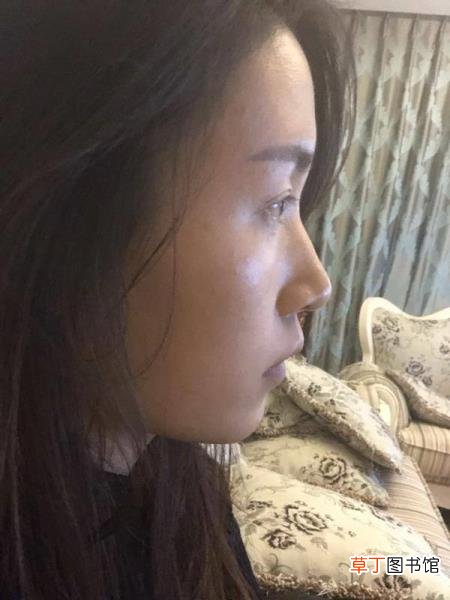 隆鼻消肿后鼻子会矮多少 鼻头多久消肿