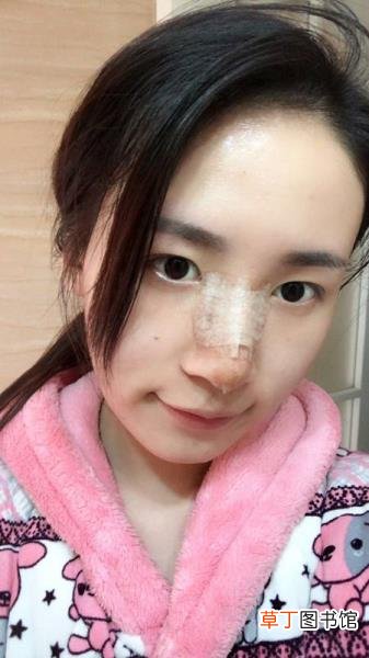 隆鼻消肿后鼻子会矮多少 鼻头多久消肿