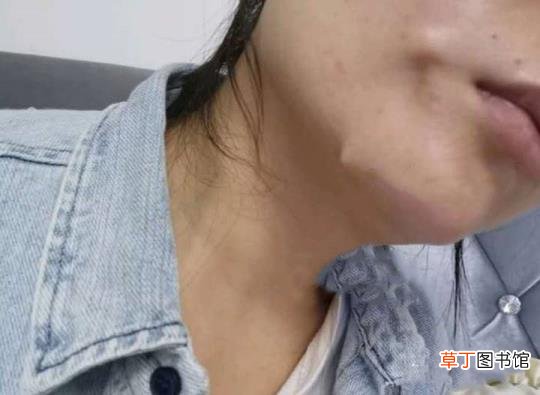 做线雕鼻好不好,有什么危害 线雕鼻子能保持多久
