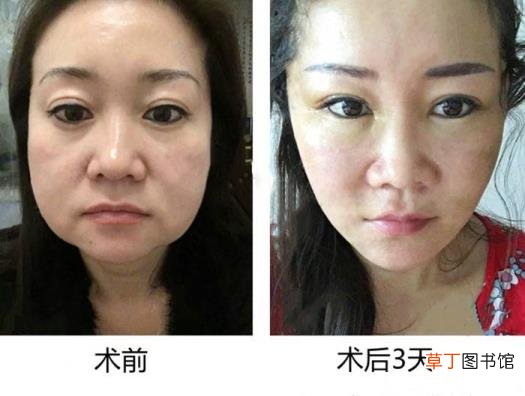 做线雕鼻好不好,有什么危害 线雕鼻子能保持多久
