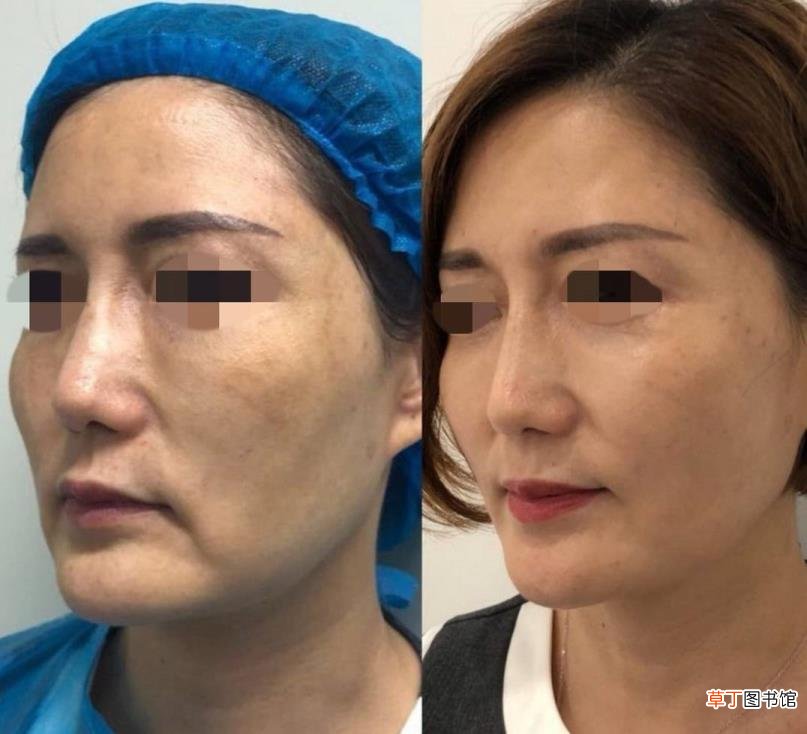 做线雕鼻好不好,有什么危害 线雕鼻子能保持多久