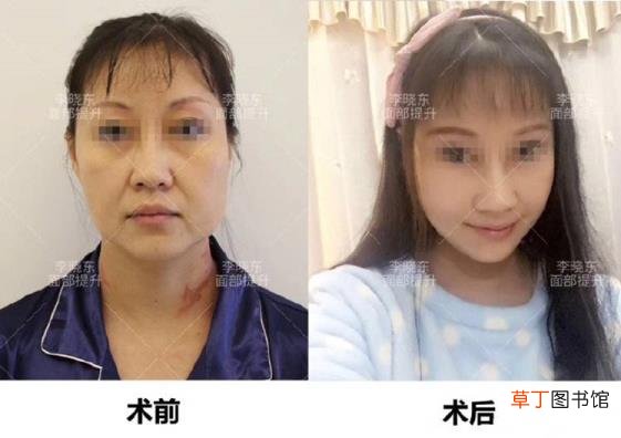 做线雕鼻好不好,有什么危害 线雕鼻子能保持多久