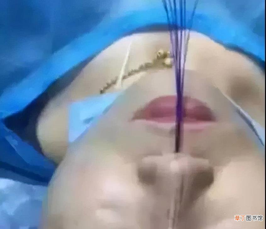 做线雕鼻好不好,有什么危害 线雕鼻子能保持多久