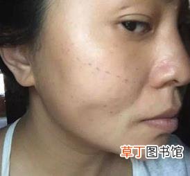 做线雕鼻好不好,有什么危害 线雕鼻子能保持多久