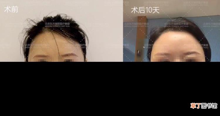 做线雕鼻好不好,有什么危害 线雕鼻子能保持多久