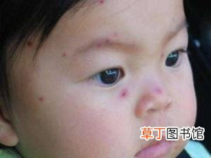 青少年得水痘几天后能康复 小孩水痘多久能好