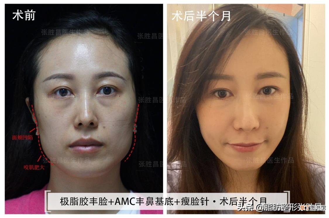 第一次打瘦脸针能瘦多少 打了瘦脸针多久能瘦