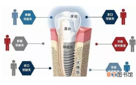 种植牙取出伤害多大 种植牙能用多久