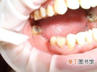 种植牙取出伤害多大 种植牙能用多久