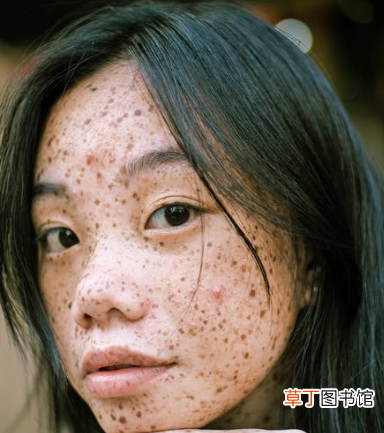 痘痘肌禁用护肤品的成分