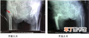骨牵引要做多久才能好 骨牵引多久