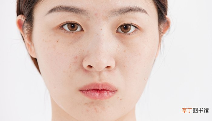 梦见自己长了满脸痘痘毁容了