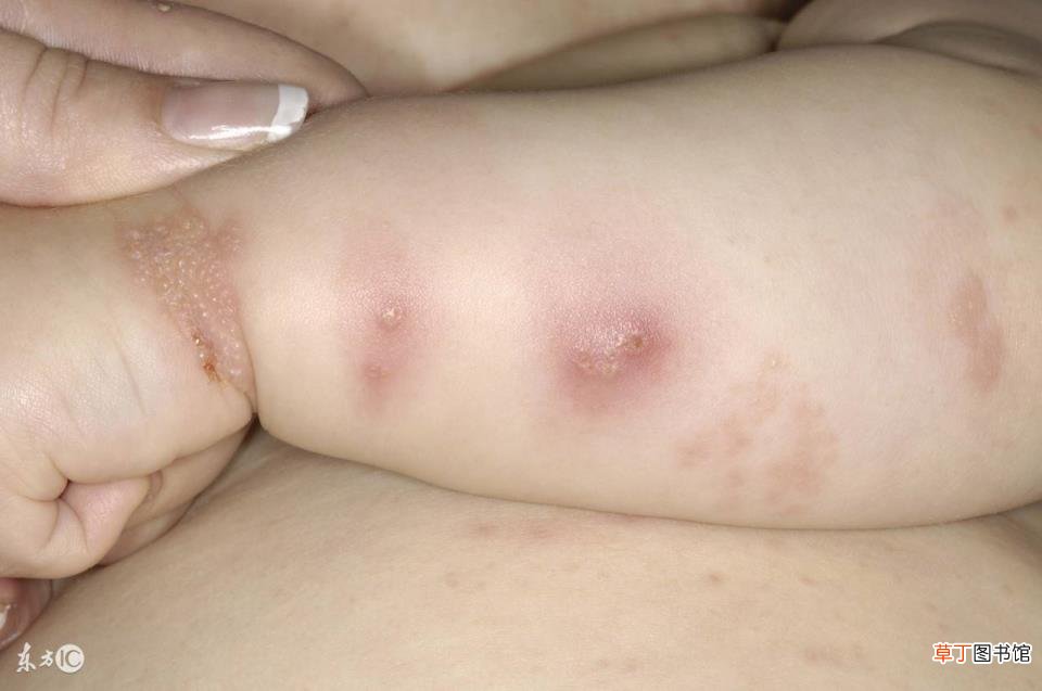 长水痘脸很油怎么洗脸 水痘长多久