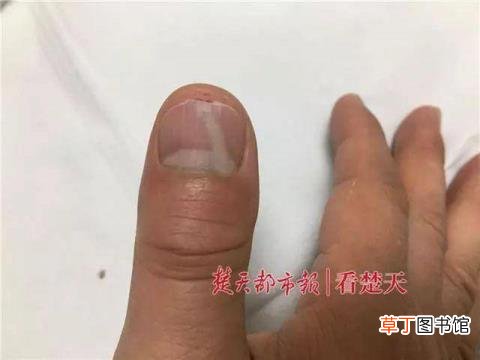 指甲完全换掉需要多少时间 拔指甲需要多久