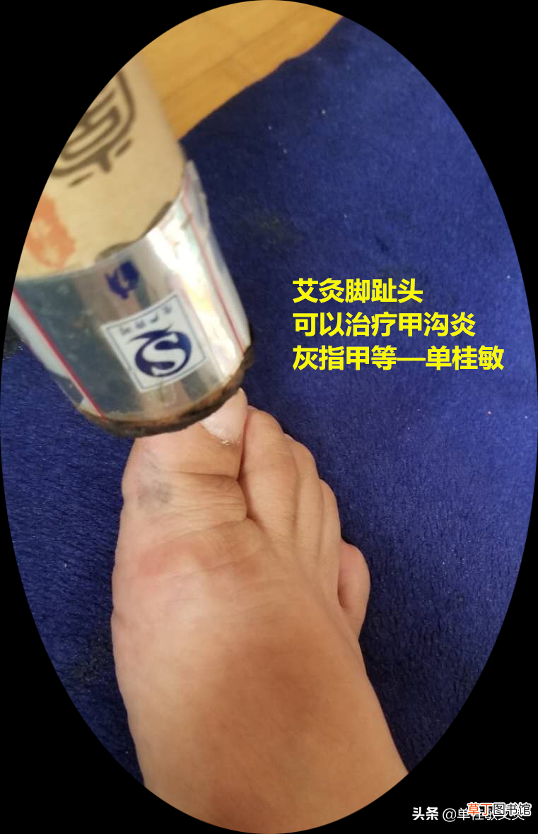 单桂敏艾灸博客 用艾灸治疗甲沟炎，灰指甲，方法简单