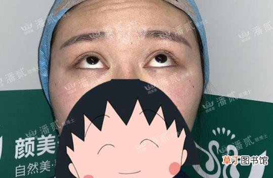眼角增生是什么样子 开眼角要多久恢复