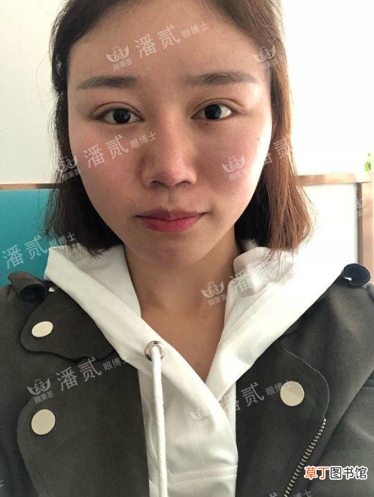 眼角增生是什么样子 开眼角要多久恢复