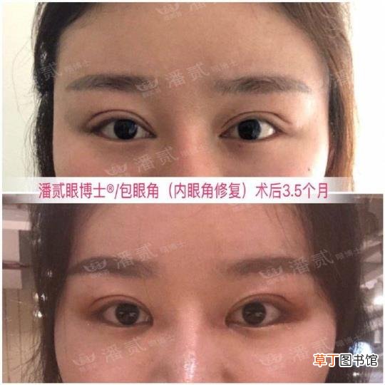 眼角增生是什么样子 开眼角要多久恢复