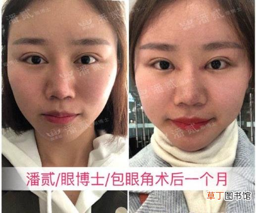 眼角增生是什么样子 开眼角要多久恢复