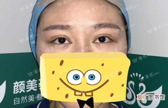 眼角增生是什么样子 开眼角要多久恢复