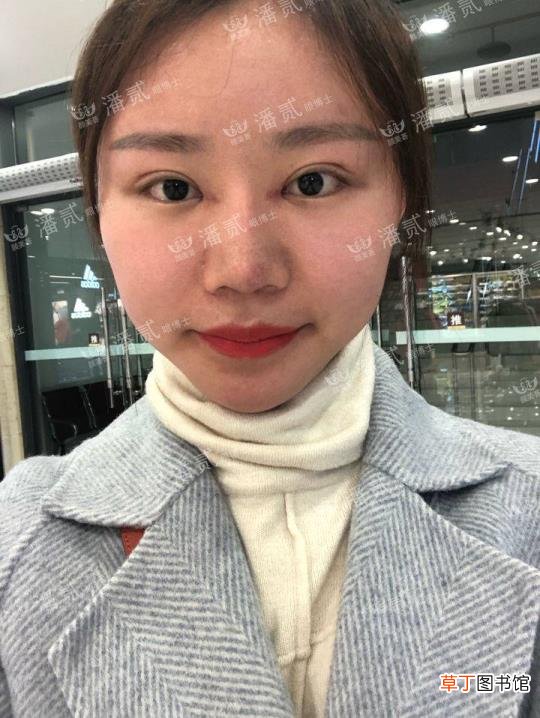 眼角增生是什么样子 开眼角要多久恢复