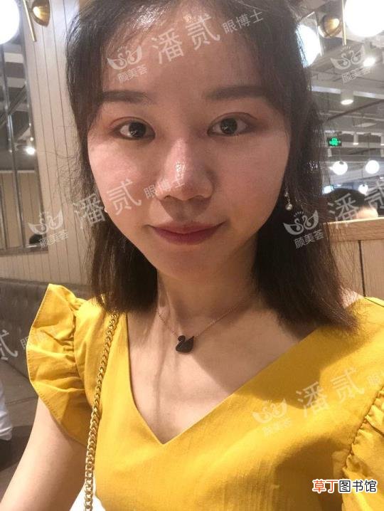 眼角增生是什么样子 开眼角要多久恢复