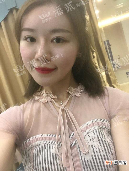 眼角增生是什么样子 开眼角要多久恢复