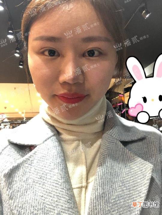 眼角增生是什么样子 开眼角要多久恢复