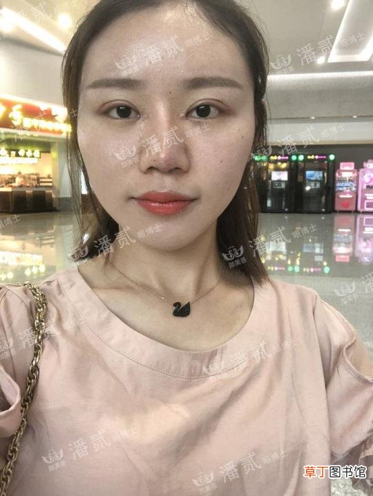 眼角增生是什么样子 开眼角要多久恢复