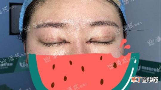 眼角增生是什么样子 开眼角要多久恢复