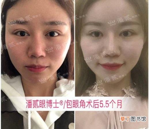 眼角增生是什么样子 开眼角要多久恢复