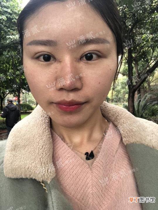 眼角增生是什么样子 开眼角要多久恢复