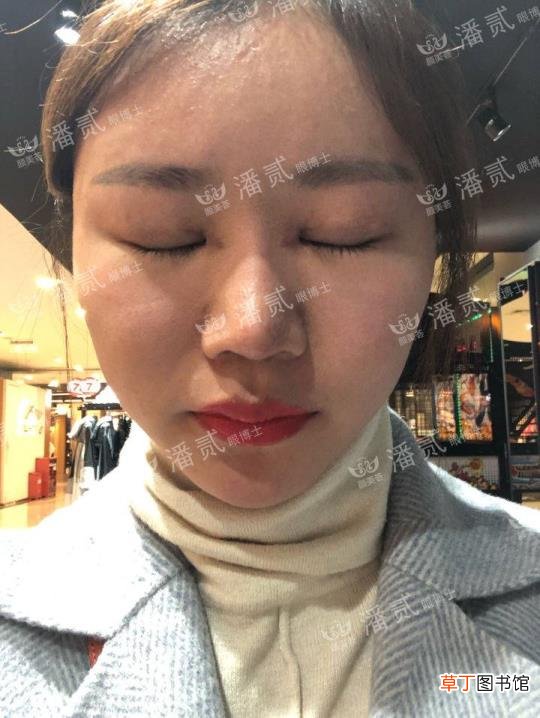 眼角增生是什么样子 开眼角要多久恢复