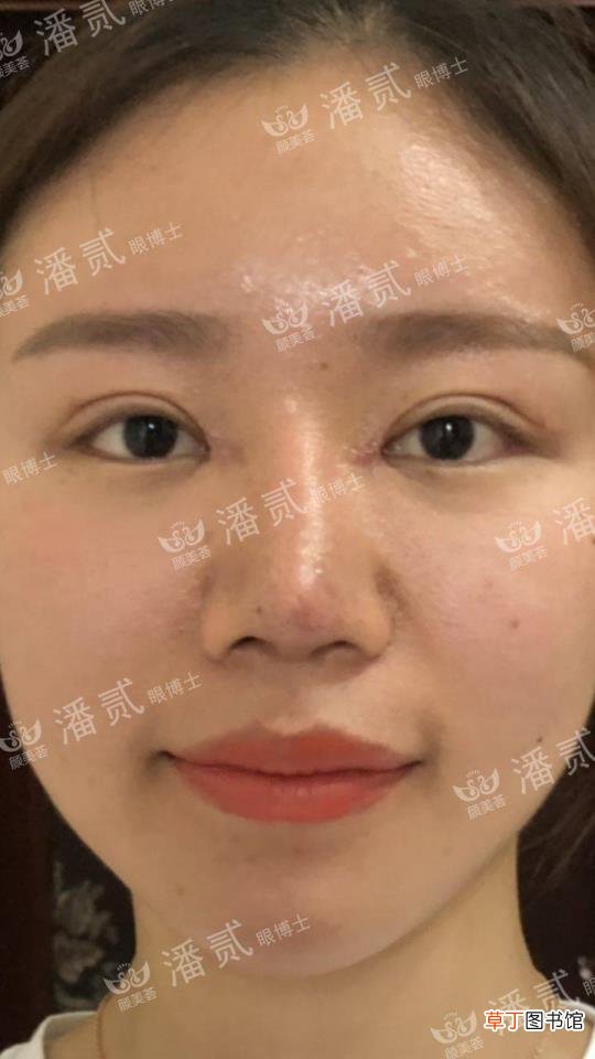 眼角增生是什么样子 开眼角要多久恢复
