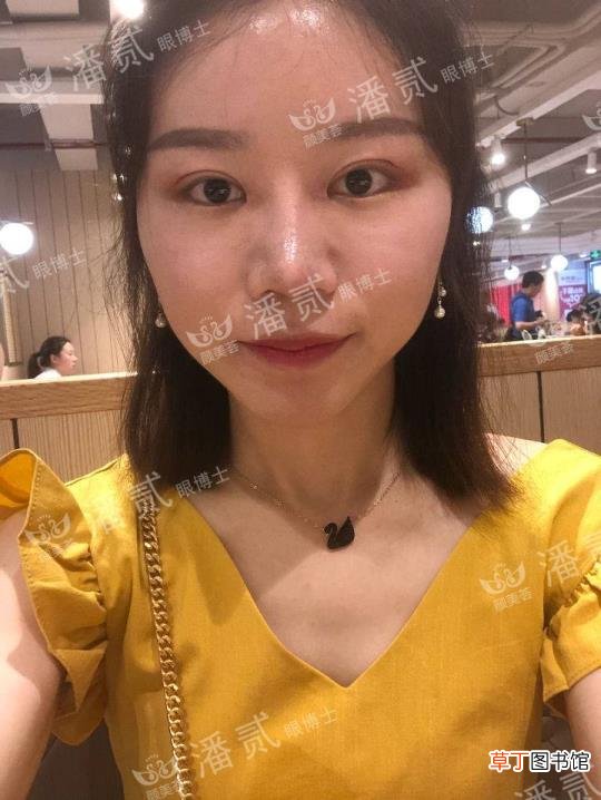 眼角增生是什么样子 开眼角要多久恢复